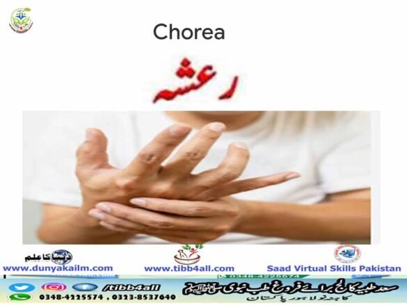 Chorea(رعشہ)