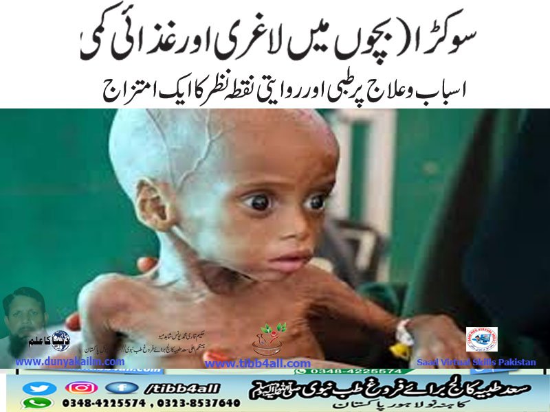سوکڑا (بچوں میں لاغری اور غذائی کمی)